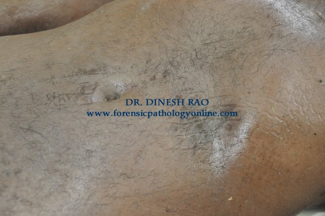 imprint abrasion-external cloth marking